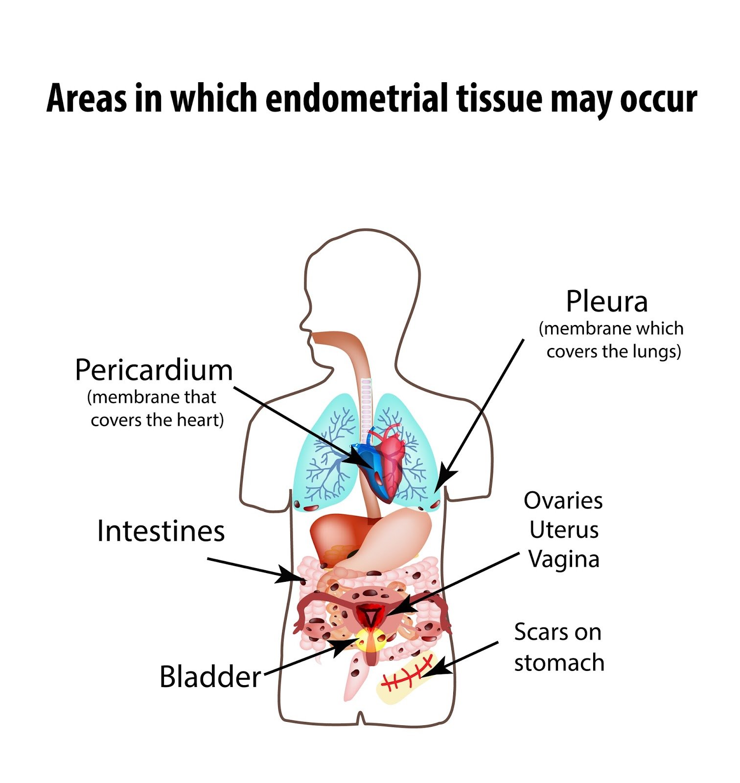 Endometriosis and IBS - The Importance of Getting the Right Diagnosis